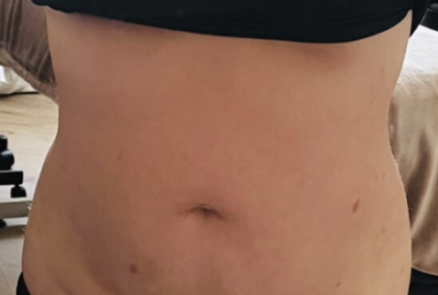 cupping, vacuüm, Chinese geneeskunde, behandeling, ontspanning, bloeddoorstroming, acupunctuur, alternatieve geneeskunde, gezondheid, buikomvang, cellulitis, lymfedrainage, massage, huid, ontgiften, ontgiftingsproces, reiniging, gifstoffen, afvalstoffen, ontlasting, urine, water, thee, groene smoothie, sapvasten, vasten, voeding, dieet, plantaardig, veganistisch, vegetarisch, eiwitten, koolhydraten, vetten, vezels, vitamines, mineralen, superfoods, antioxidanten, peterselie, gember, kurkuma, knoflook, citroen, appelazijn, chlorella, spirulina, matcha, kruiden, supplementen, gezond leven.