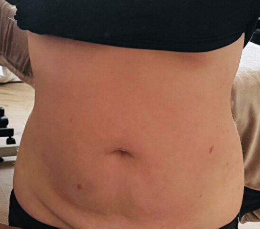 cupping, vacuüm, Chinese geneeskunde, behandeling, ontspanning, bloeddoorstroming, acupunctuur, alternatieve geneeskunde, gezondheid, buikomvang, cellulitis, lymfedrainage, massage, huid, ontgiften, ontgiftingsproces, reiniging, gifstoffen, afvalstoffen, ontlasting, urine, water, thee, groene smoothie, sapvasten, vasten, voeding, dieet, plantaardig, veganistisch, vegetarisch, eiwitten, koolhydraten, vetten, vezels, vitamines, mineralen, superfoods, antioxidanten, peterselie, gember, kurkuma, knoflook, citroen, appelazijn, chlorella, spirulina, matcha, kruiden, supplementen, gezond leven.