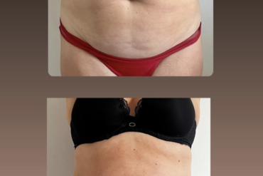 Ontdek het geheime wapen voor een platte buik: Cupping!